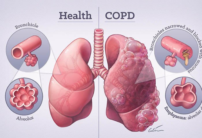 copr lungs