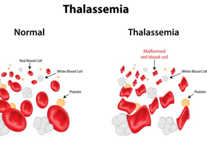 thalassemia